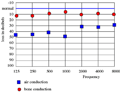 impacted wax audiogram