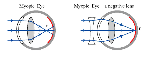 Myopic Eye